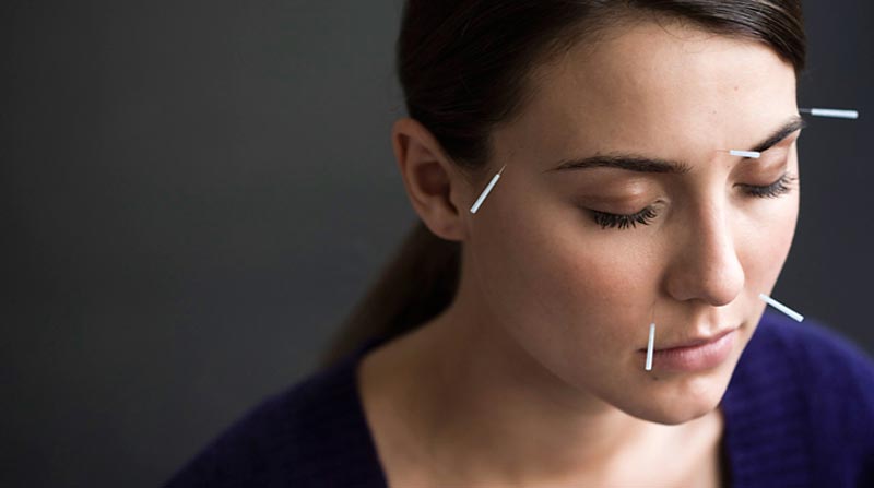 فواید طب سوزنی