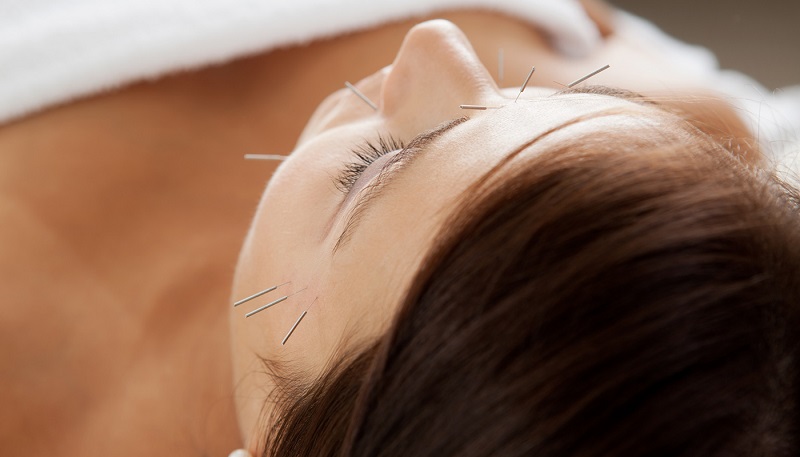 درمان سردرد با طب سوزنی