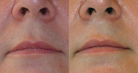 لیزر موهای زائد صورت در آقایان