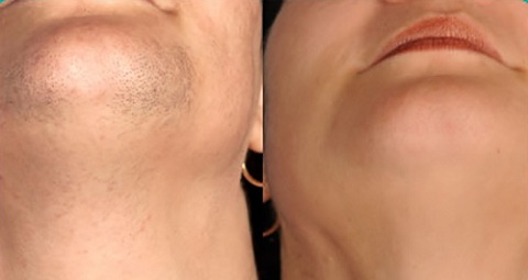 لیزر موهای زائد صورت در خانم­ها