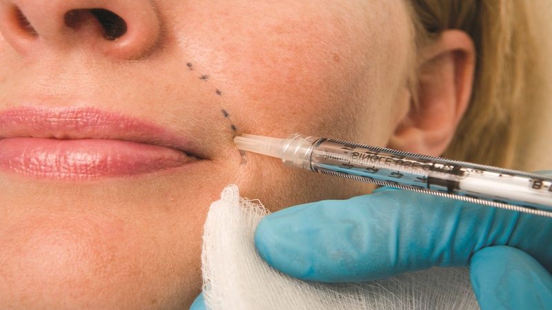 بهترین مطب زیبایی اصفهان برطرف کردن خط لبخند با تزریق ژل