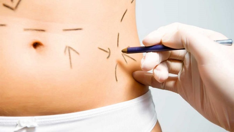 هایفو لاغری اصفهان پاسخ به سوالات پیرامون هایفو لاغری