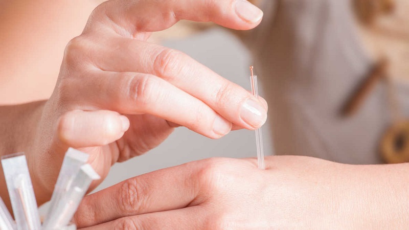 طب سوزنی اصفهان خطرات و فواید استفاده از روش طب سوزنی