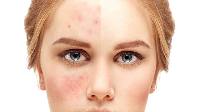 بهترین مطب زیبایی اصفهان پانچ صورت