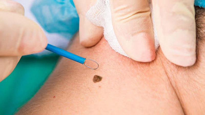 بهترین مطب زیبایی اصفهان برداشتن خال با لیزر