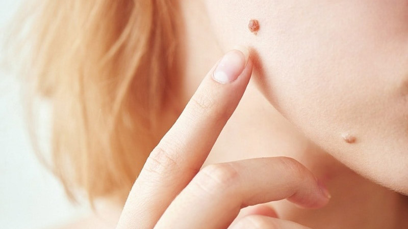 بهترین میکرودرم ابریژن اصفهان روش های از بین بردن خال های پوست