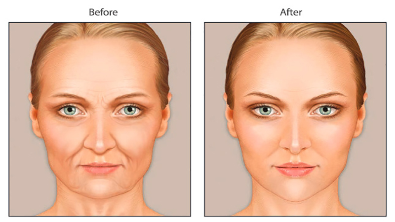بهترین مطب زیبایی اصفهان | تزریق چربی در لیفت صورت