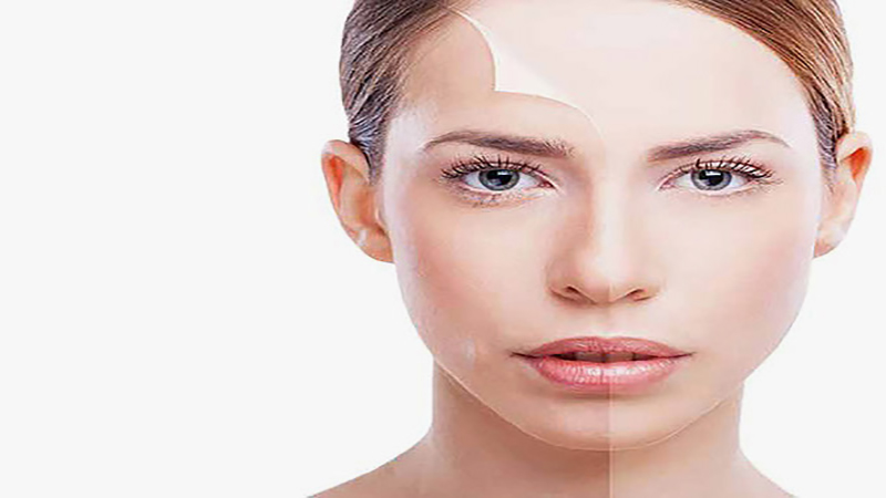 بهترین مطب زیبایی اصفهان |پیلینگ شیمیایی سبک