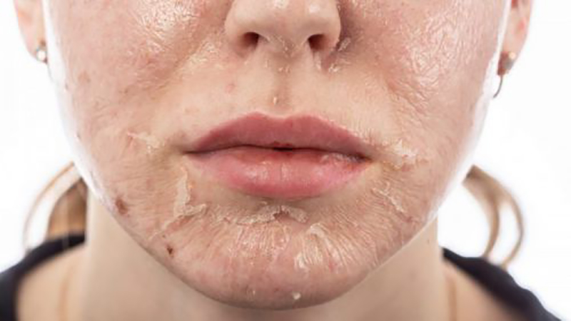 بهترین مطب زیبایی اصفهان | پیلینگ شیمیایی متوسط