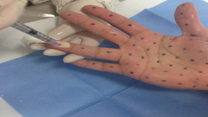 تزریق بوتاکس برای تعریق زیاد بدن و اثرات آن | بهترین مطب زیبایی اصفهان