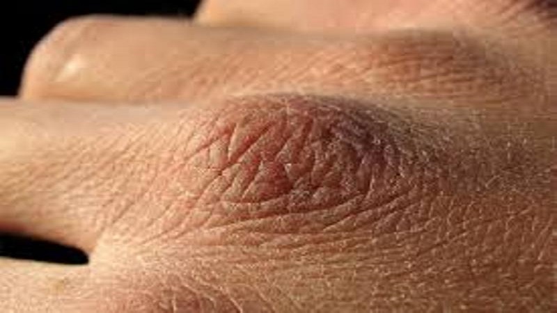 خشکی پوست-علائم و نشانه ها و دلایل آن | بهترین مطب زیبایی اصفهان