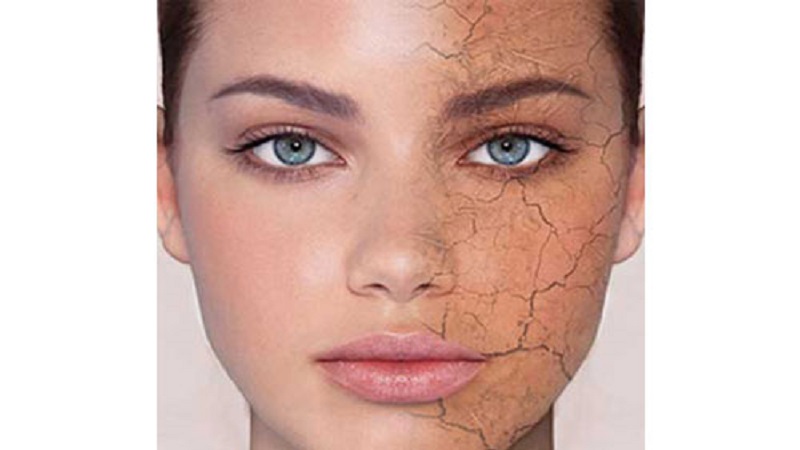 خشکی پوست-علائم و نشانه ها و دلایل آن | بهترین مطب زیبایی اصفهان