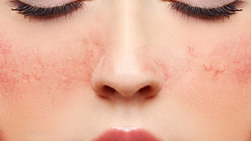 کم آبی پوست-علائم و نشانهها و علت آن | بهترین مطب زیبایی اصفهان