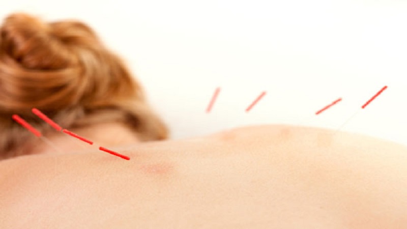 طب سوزنی در بیماریهای زنان-موارد درمان | بهترین مطب زیبایی اصفهان