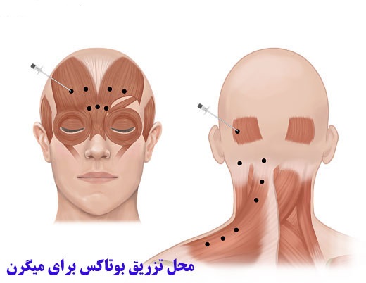 نحوه‌ی انجام بوتاکس میگرن و تعداد جلسات مورد نیاز | بهترین مطب زیبایی اصفهان
