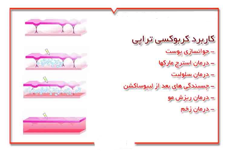 کاربردهای کربوکسی تراپی و منع انجام آن | بهترین مطب زیبایی اصفهان