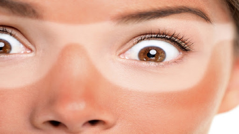 انواع آفتاب سوختگی | بهترین مطب زیبایی اصفهان