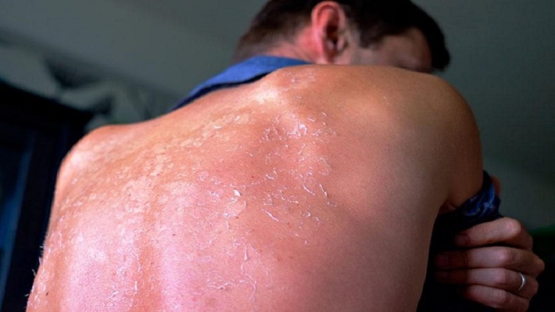 درمان آفتاب سوختگی | بهترین مطب زیبایی اصفهان