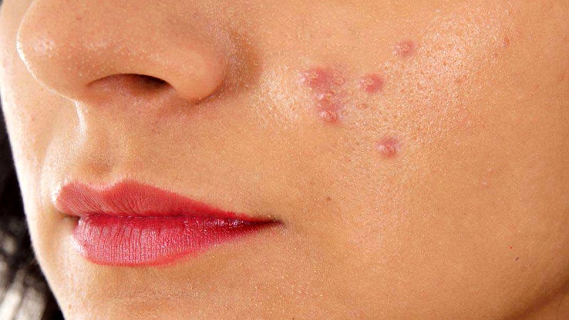 دلیل بروز جوش های زیر پوستی | بهترین مطب زیبایی اصفهان