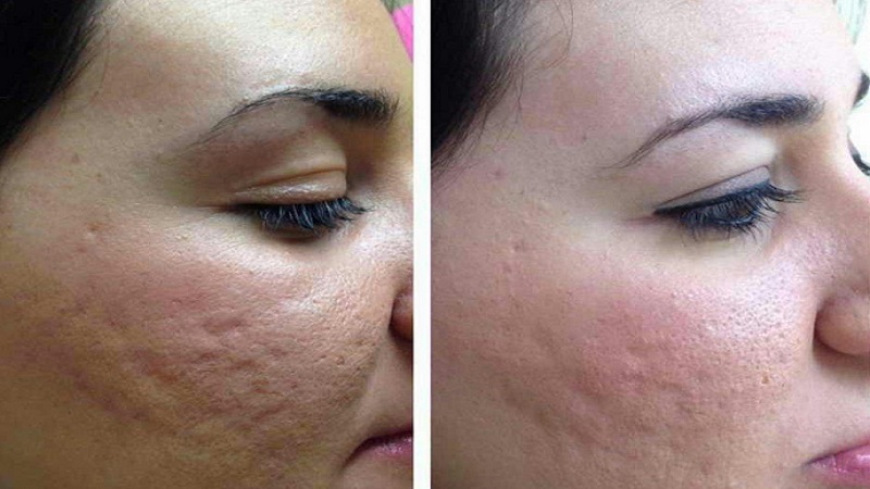 مزایا و نتایج مزونیدلینگ | بهترین مطب زیبایی اصفهان