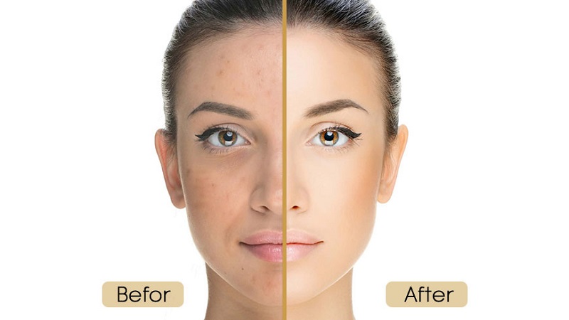 میکرونیدلینگ به چه کسانی توصیه نمی‌شود و عوارض آن | بهترین مطب زیبایی اصفهان