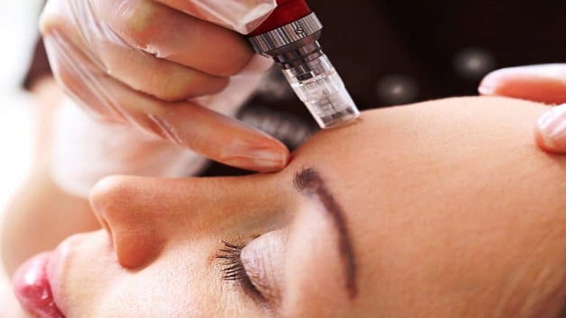 میکرونیدلینگ، روشها و کاربردها و ماندگاری | بهترین مطب زیبایی اصفهان