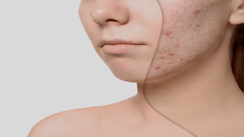 آیا جای جوش پس از لیزر باقی می ماند؟ | بهترین مطب زیبایی اصفهان