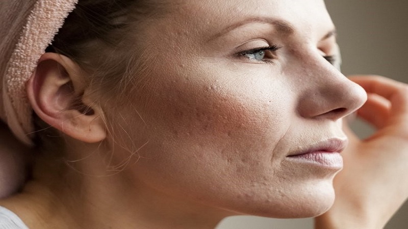 آیا جای جوش پس از لیزر باقی می ماند؟ | بهترین مطب زیبایی اصفهان