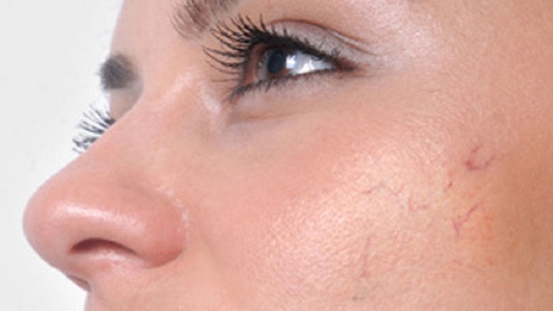 درمان ضایعات رنگی پوست با لیزر | بهترین مطب زیبایی اصفهان