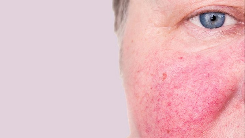 درمان ضایعات رنگی پوست با لیزر | بهترین مطب زیبایی اصفهان