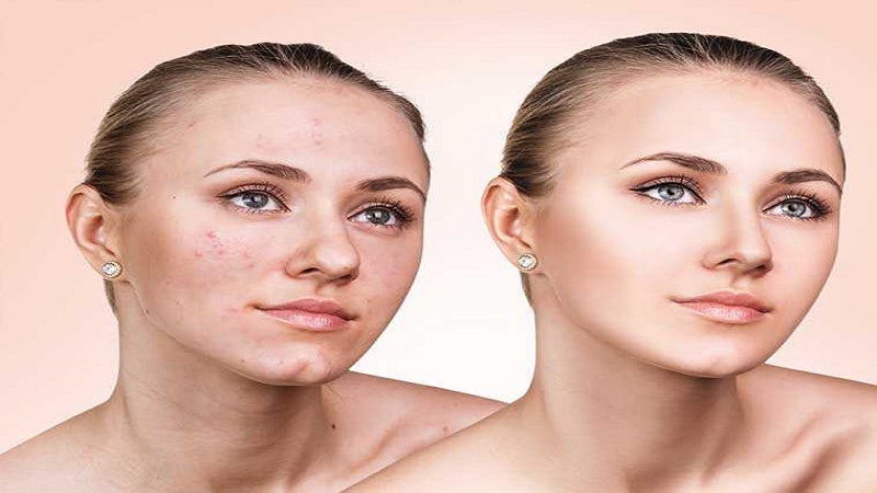 کاربردها و تاثیرات هیدرودرم ابریژن | بهترین مطب زیبایی اصفهان