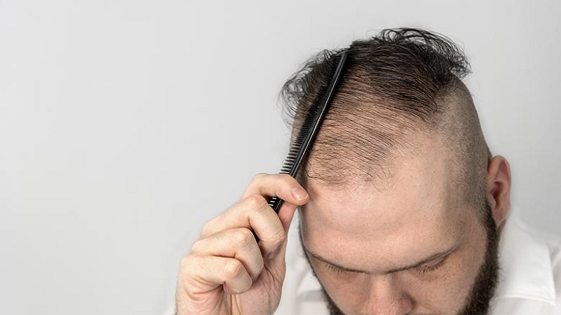 دلایل انواع خاص ریزش مو و دلایل آن | بهترین مطب زیبایی اصفهان