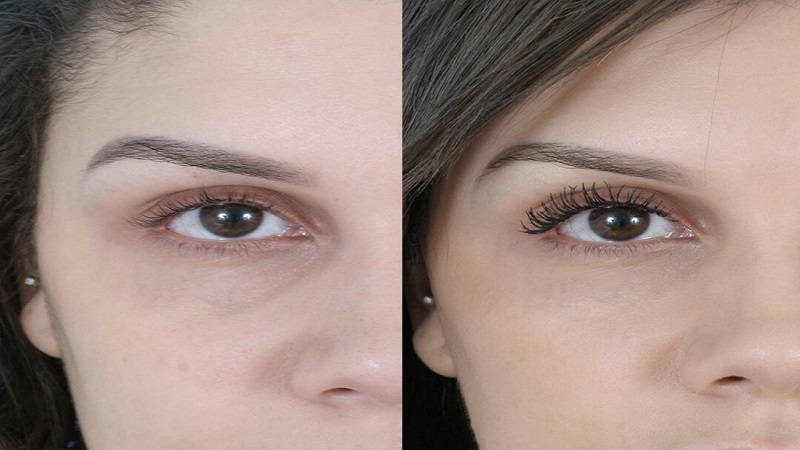 عوارض جانبی تزریق فیلر زیر چشم | بهترین مطب زیبایی اصفهان