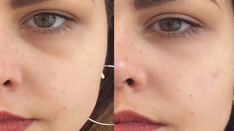 عوارض جانبی تزریق فیلر زیر چشم | بهترین مطب زیبایی اصفهان