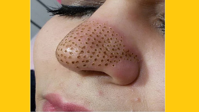 پلاسما جت بینی مناسب چه افرادی نیست | بهترین مطب زیبایی اصفهان