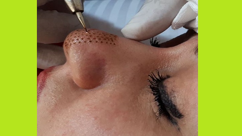 پلاسما جت بینی مناسب چه افرادی نیست | بهترین مطب زیبایی اصفهان