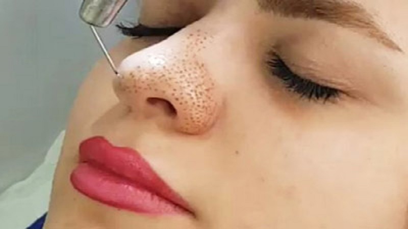 پلاسما جت بینی چیست؟ | بهترین مطب زیبایی اصفهان