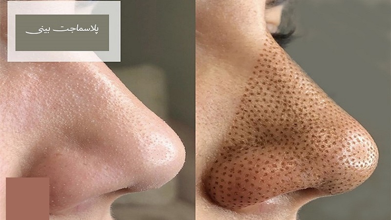 پلاسما جت بینی چیست؟ | بهترین مطب زیبایی اصفهان