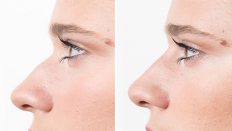 مراقبت های قبل از پلاسما جت بینی برای | بهترین مطب زیبایی اصفهان