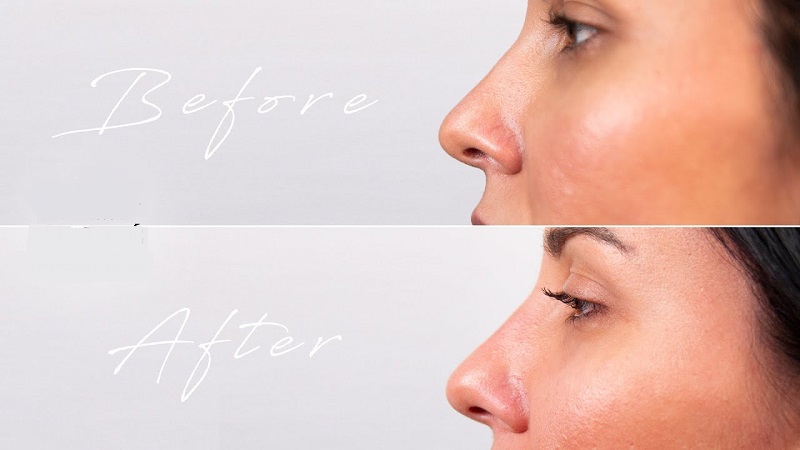 مراقبت های قبل از پلاسما جت بینی برای | بهترین مطب زیبایی اصفهان