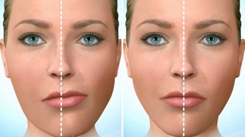 درمان عدم تقارن صورت با بوتاکس | بهترین مطب زیبایی اصفهان