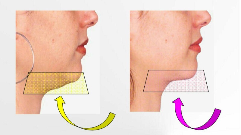 مزایای درمان غبغب با روش RF | بهترین مطب زیبایی اصفهان