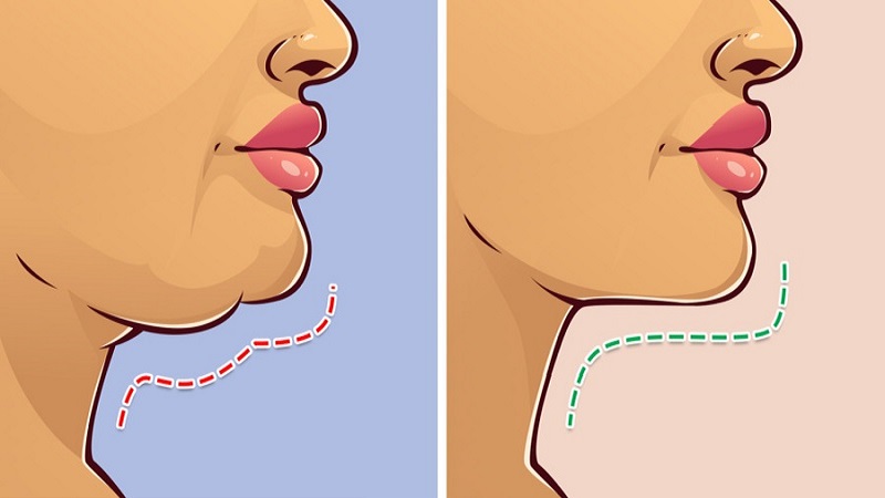 مزایای درمان غبغب با روش RF | بهترین مطب زیبایی اصفهان