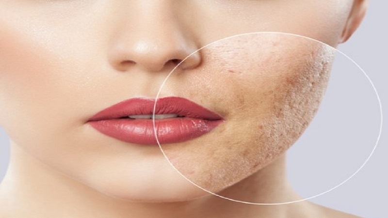 بهترین مطب زیبایی اصفهان | مراحل درمان سابسیژن