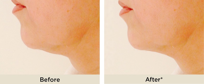 بهترین مطب زیبایی اصفهان | جوانسازی و لیفت صورت با لیزر اندولیفت