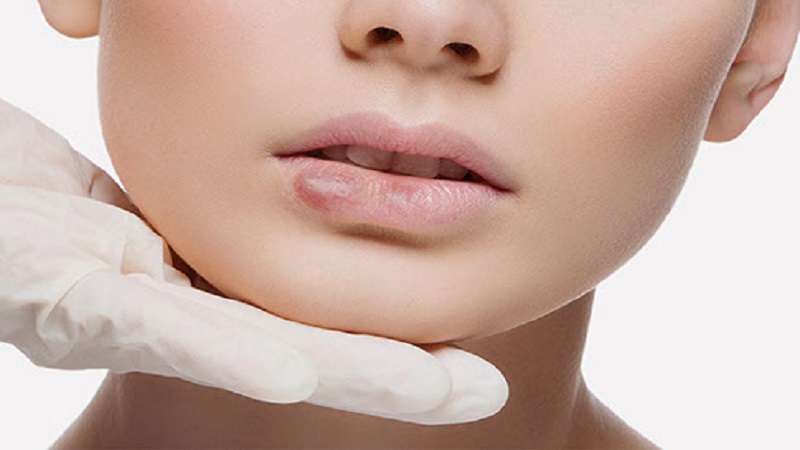 بهترین مطب زیبایی اصفهان | درمان گرانولوم تزریق ژل لب