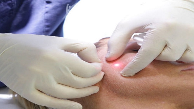 بهترین مطب زیبایی اصفهان | مزیت و کاربرد جوانسازی پوست با لیزر اندولیفت