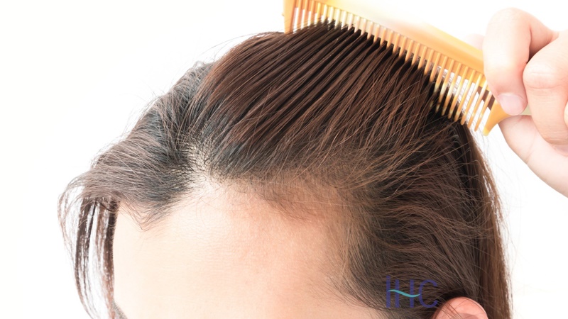 فواید و نحوه انجام میکرو اسکالپ | بهترین مطب زیبایی اصفهان