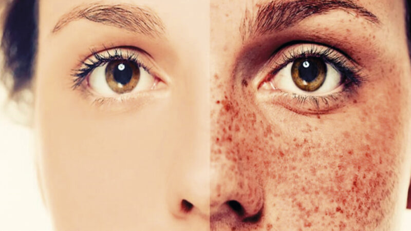 علل بروز ماسک حاملگی چیست؟ | بهترین مطب زیبایی اصفهان