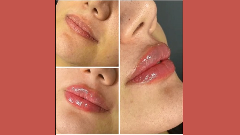 نمونه تزریق فیلر لب | بهترین مطب زیبایی اصفهان
